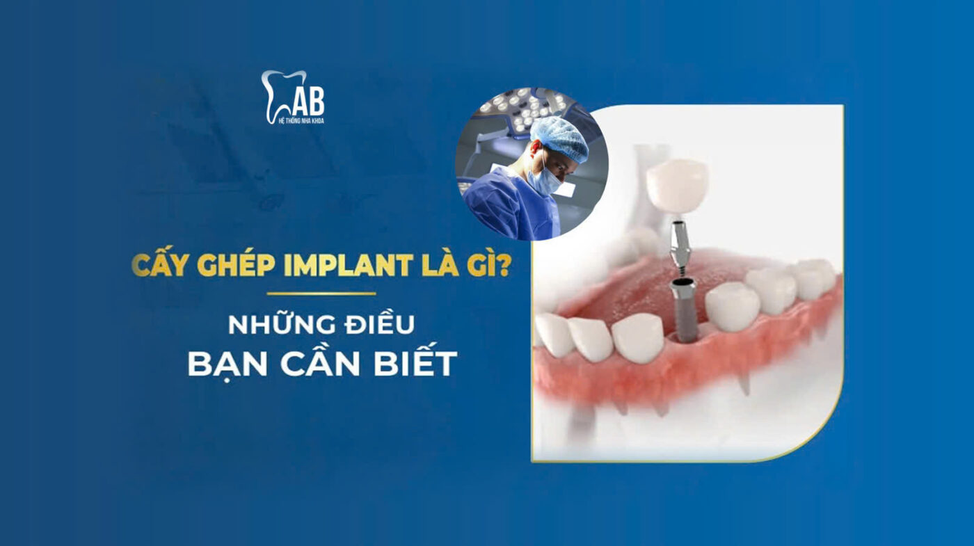 Cấy ghép implant là gì?
