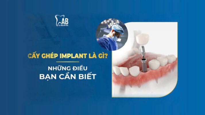 Cấy ghép implant là gì?