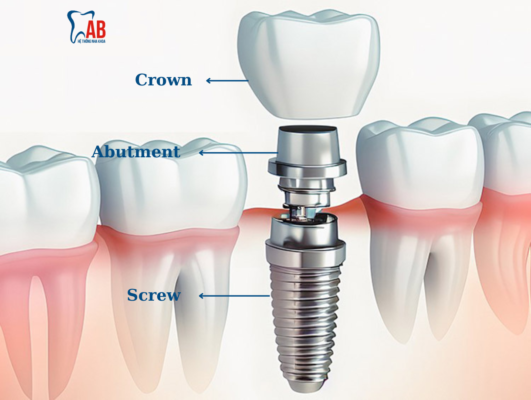 Cấu tạo răng Implant trong cấy ghép Implant