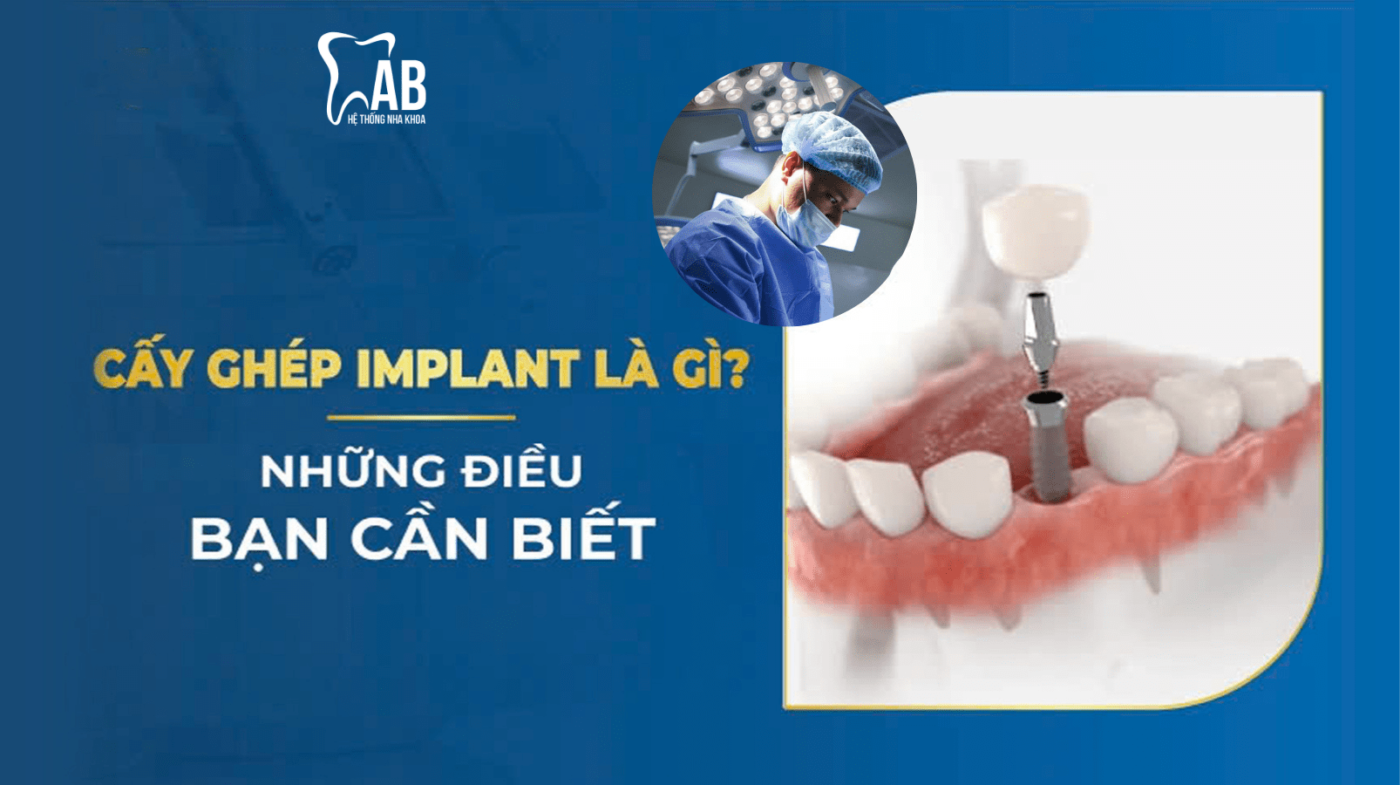 cấy ghép implant là gì?