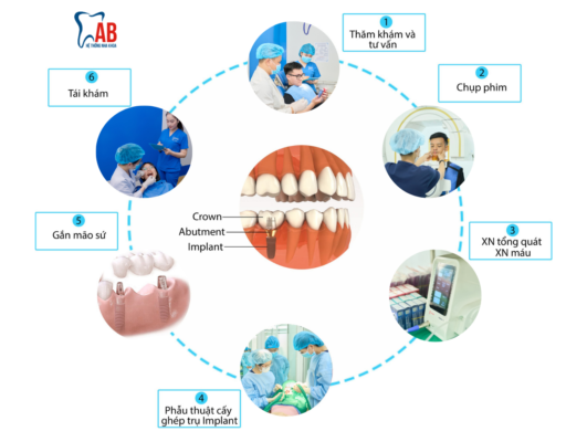 Quy trình cấy ghép implant