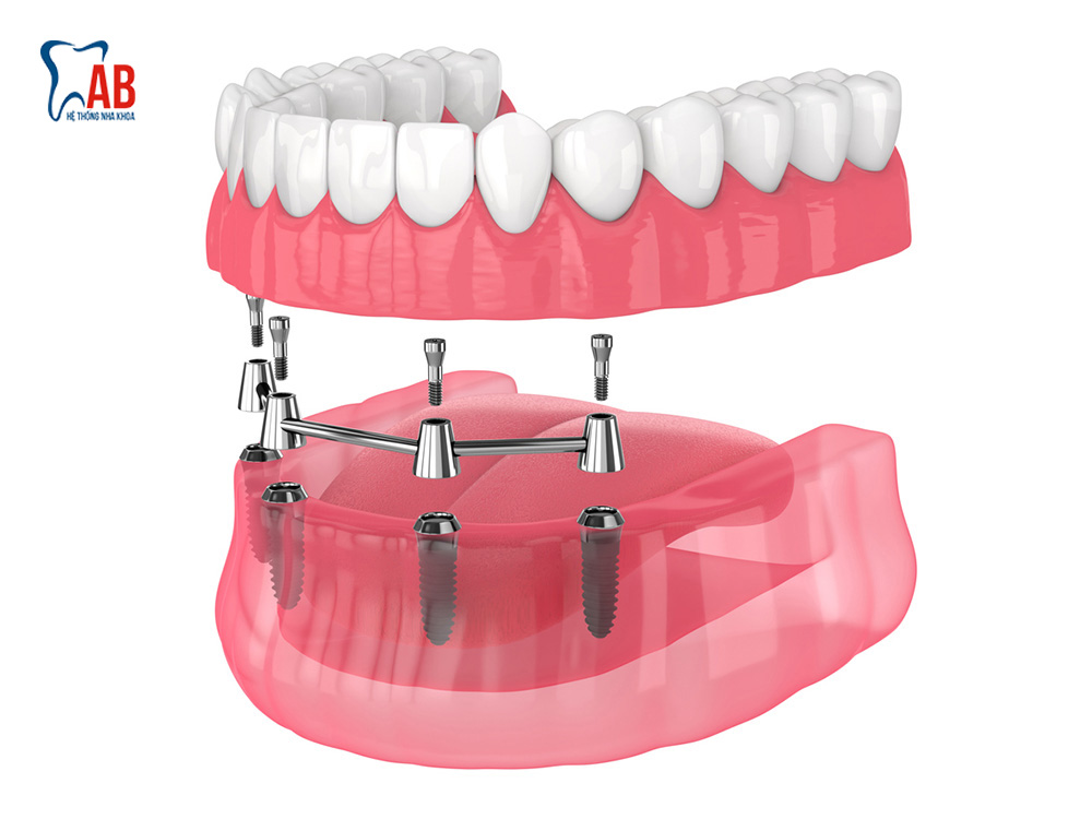 Implant All-on-4 và Implant All-on-6: Giải pháp tối ưu cho mất răng ...
