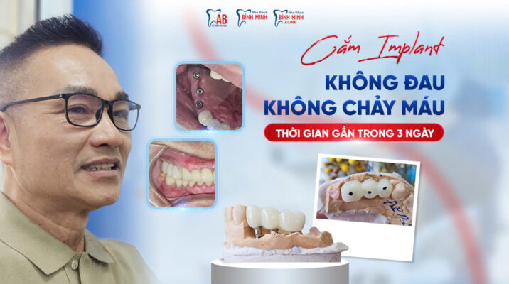 Cắm Implant không đau, không chảy máu chỉ trong 3 ngày