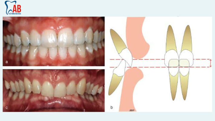 Khớp cắn sâu 2 