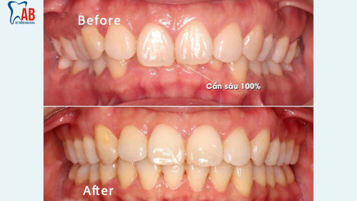 Khớp cắn sâu 3 