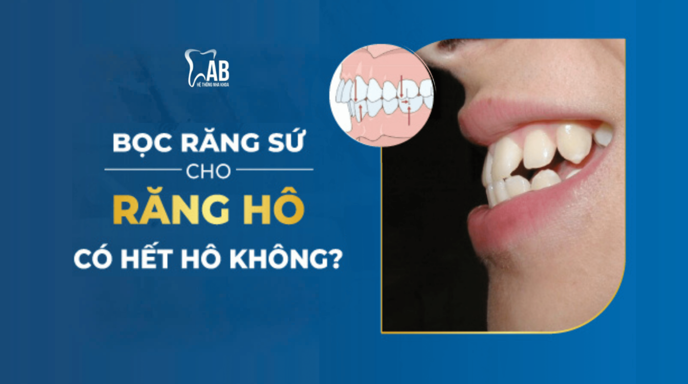 Bọc răng sứ cho răng hô có hết hô không?