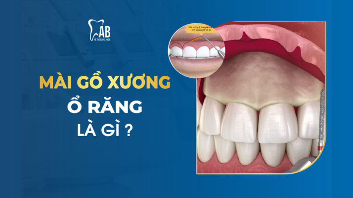Mài gồ xương ổ răng là gì?
