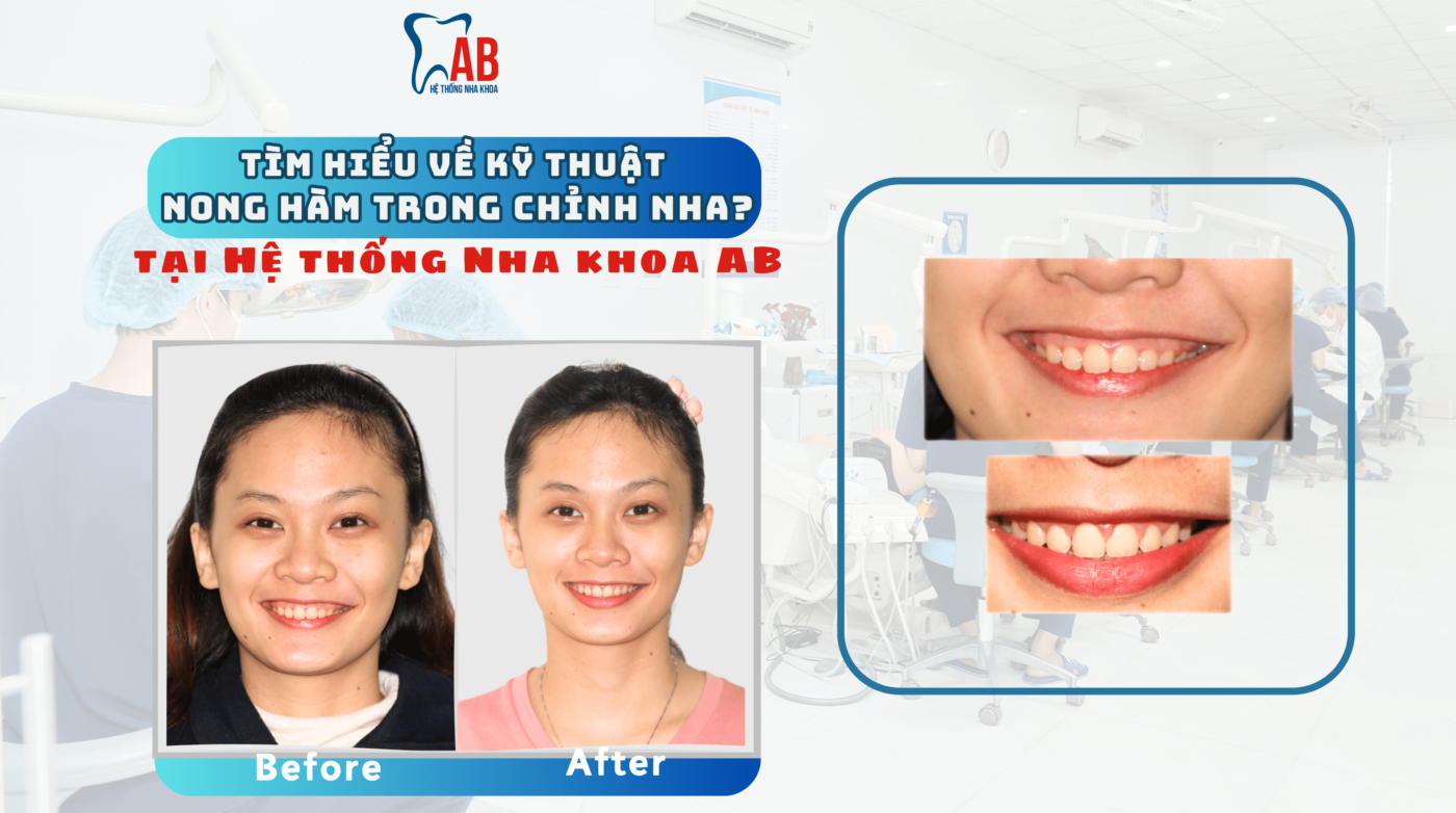 Nong hàm trong chỉnh nha