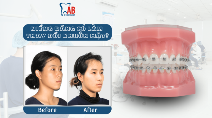Niềng răng có làm thay đổi khuôn mặt không