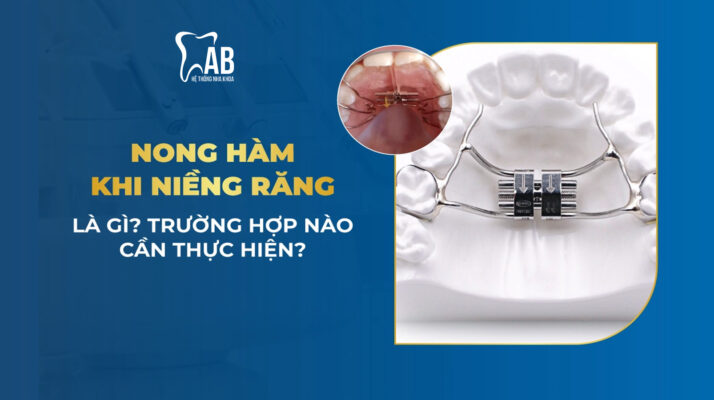 Nong hàm trong niềng răng