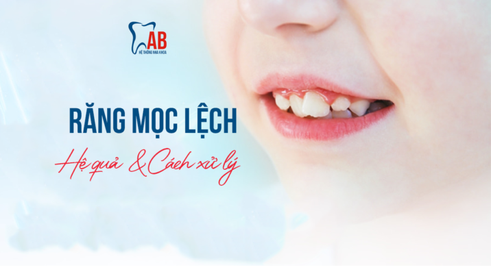 Răng Mọc Lệch: Nguyên Nhân, Dấu Hiệu, Hệ Quả Và Cách Xử Lý