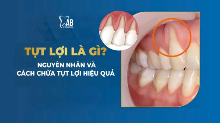 Tụt nướu là gì?