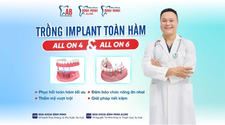Implant All-on-4 và Implant All-on-6