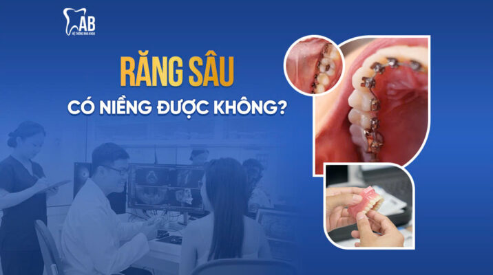 Răng sâu có niềng được không?