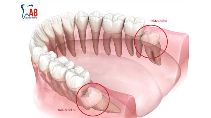 Nhổ răng khôn hàm dưới