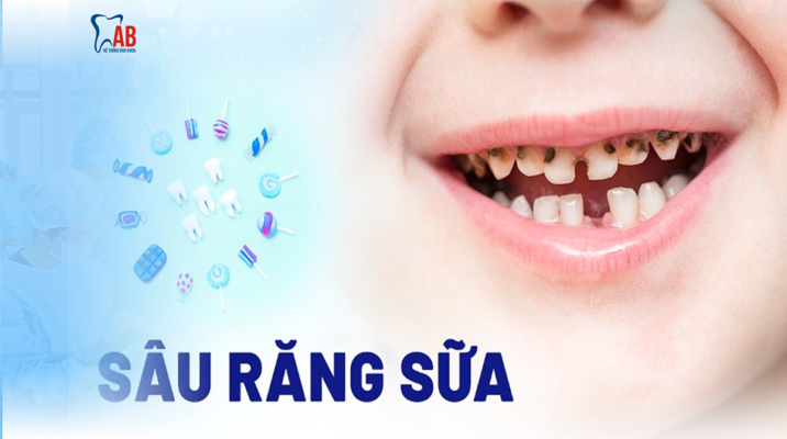 Sâu răng sữa