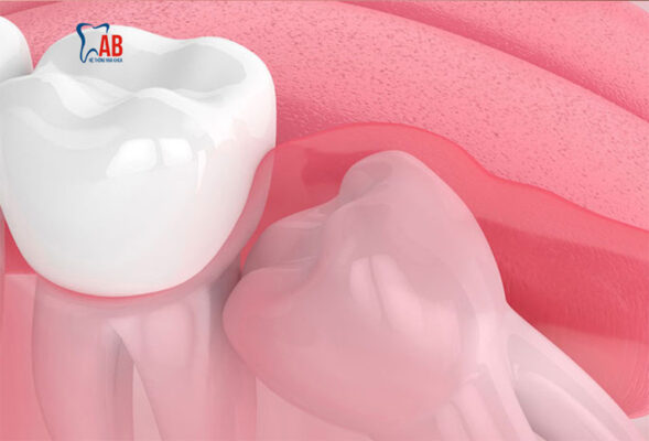 Các câu hỏi thường gặp về nhổ răng khôn?