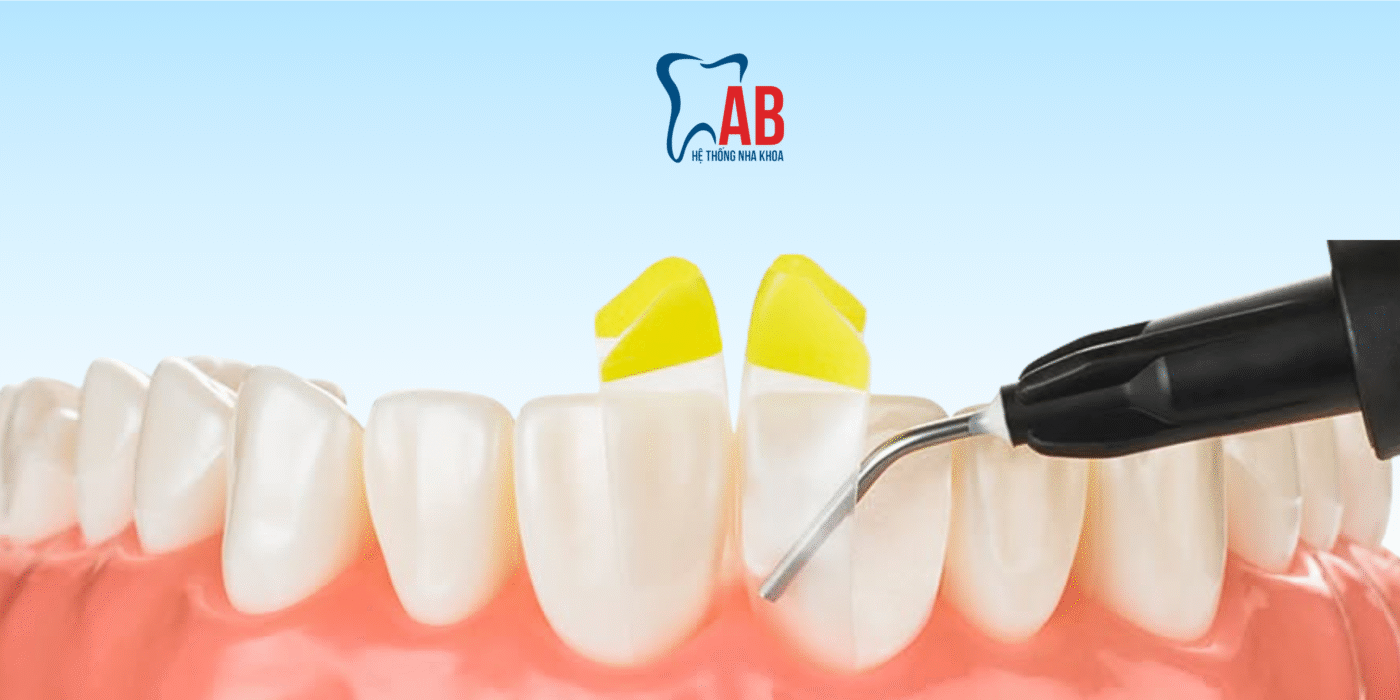 Trám răng công nghệ Bioclear